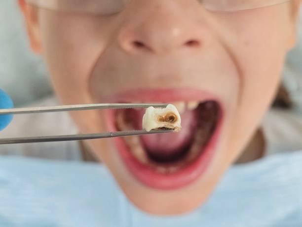 Best Broken or Chipped Tooth Repair in Millers Creek, NC